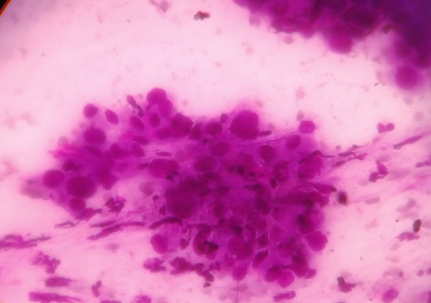 Non Healing Breast Abscess In Lactating Mother Age Of 30 Yrs